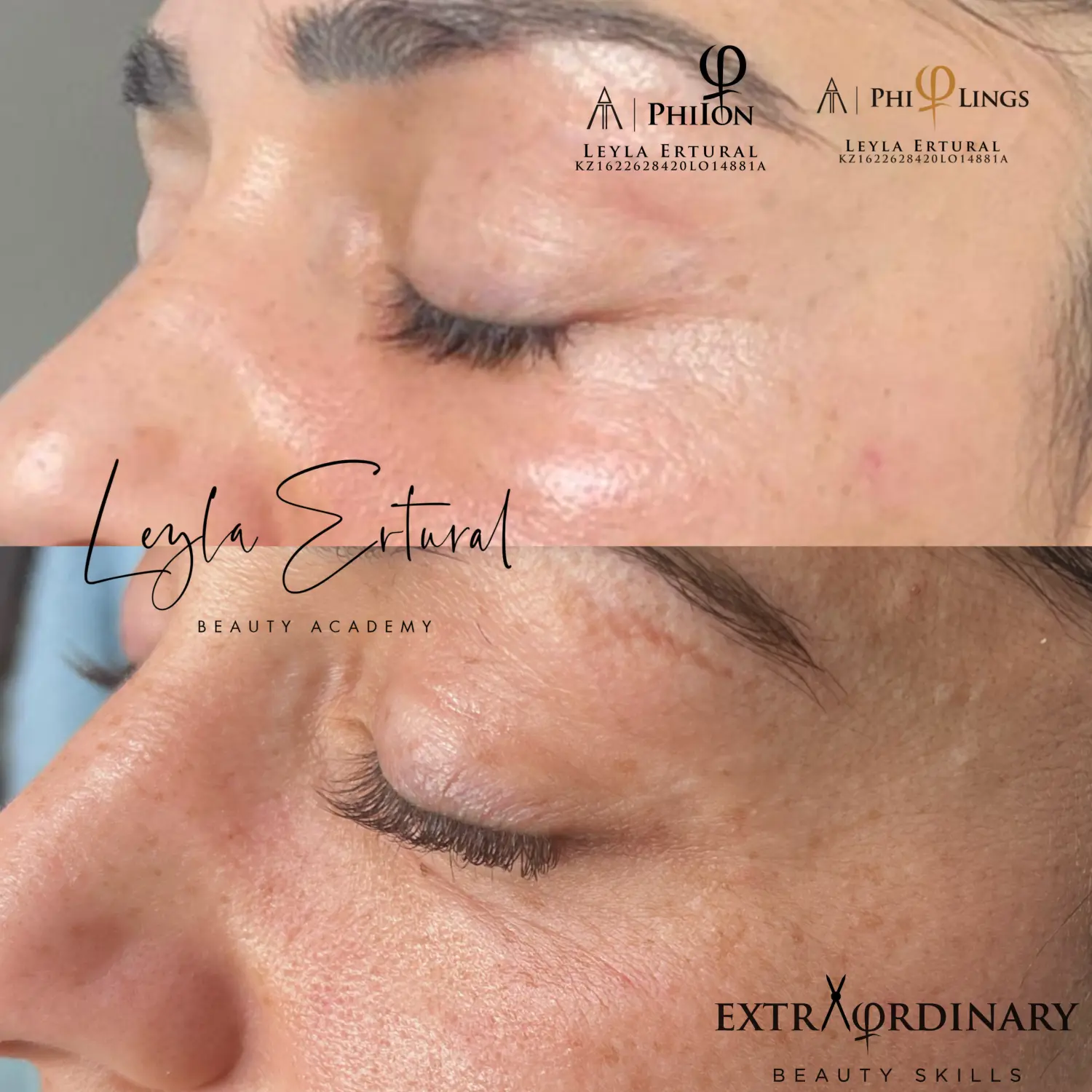 Vor und nach dem Microneedling – Leyla Ertural