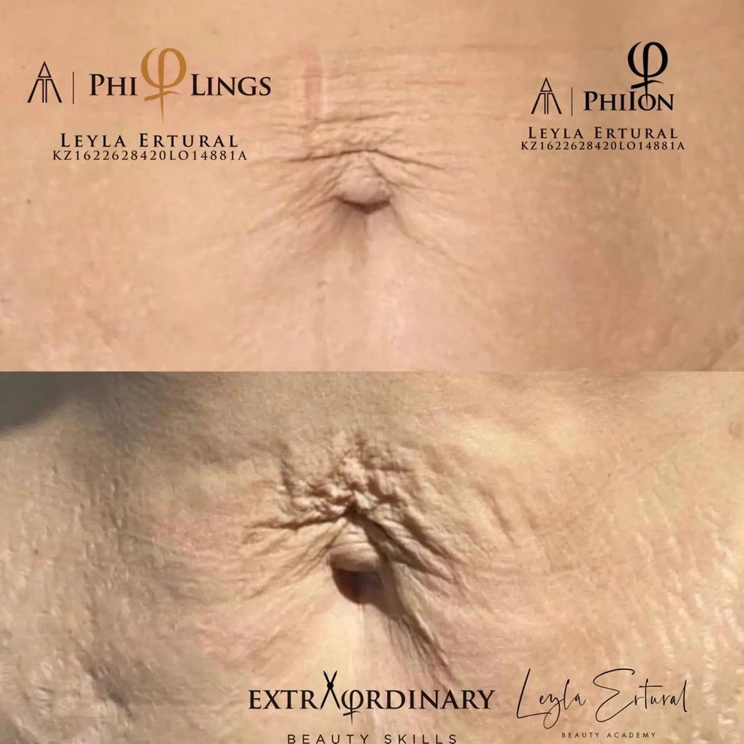 Vor und nach Radiofrequenz Needling – Leyla Ertural