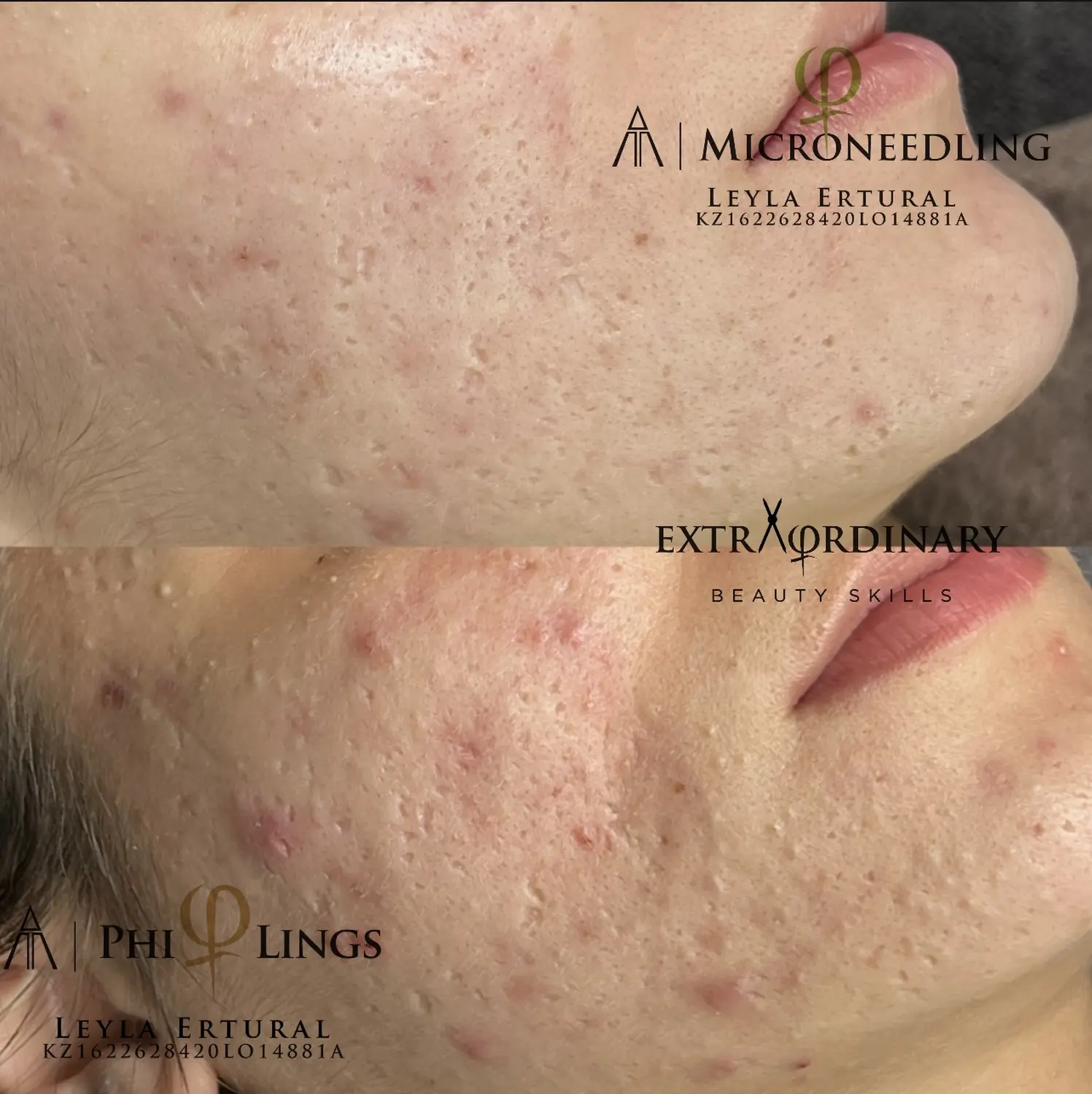 Vor und nach dem Microneedling – Leyla Ertural