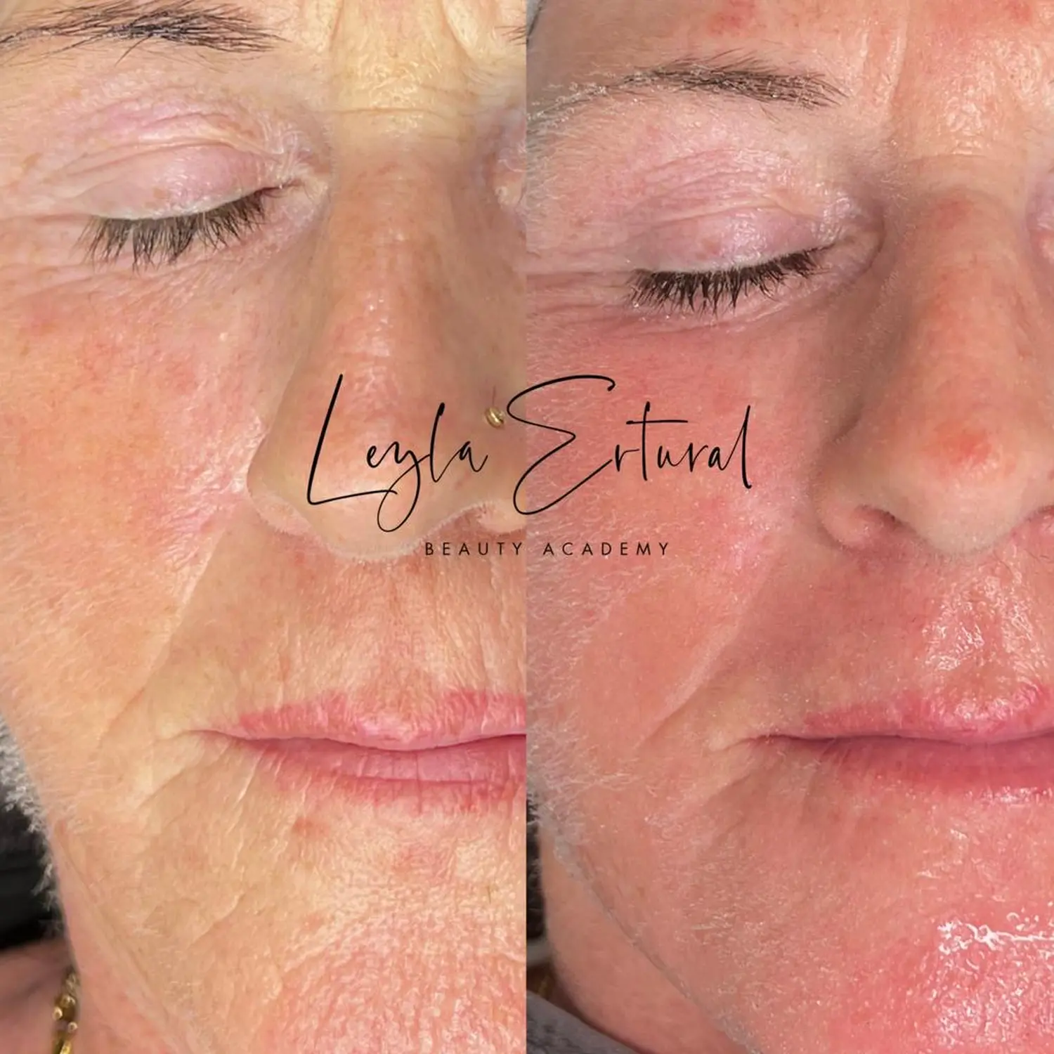 Vor und nach dem Microneedling – Leyla Ertural