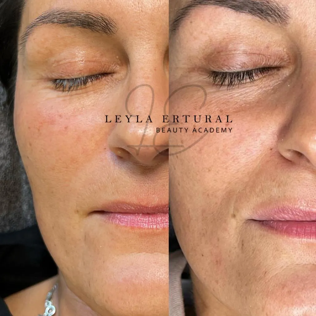 Vor und nach dem Microneedling – Leyla Ertural