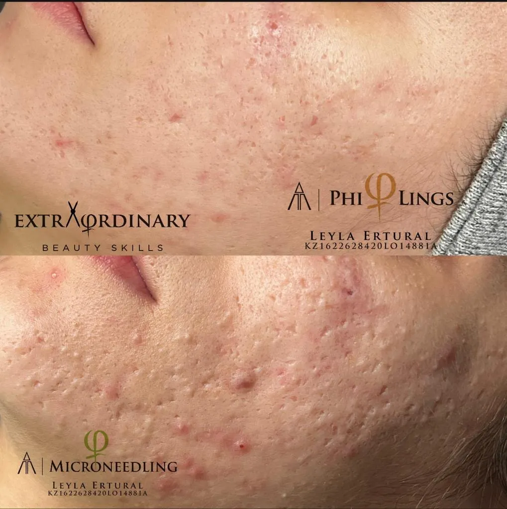 Vor und nach dem Microneedling – Leyla Ertural