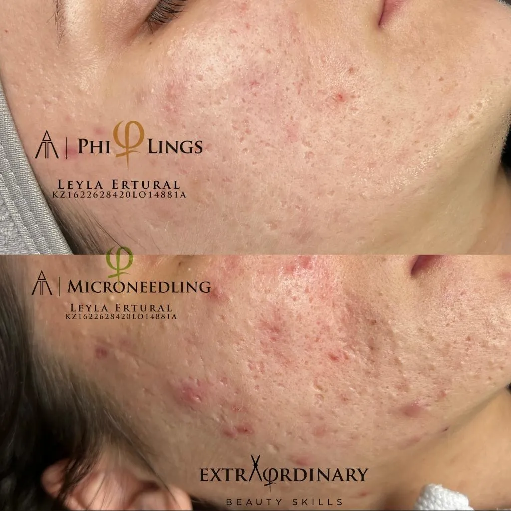 Vor und nach dem Microneedling – Leyla Ertural