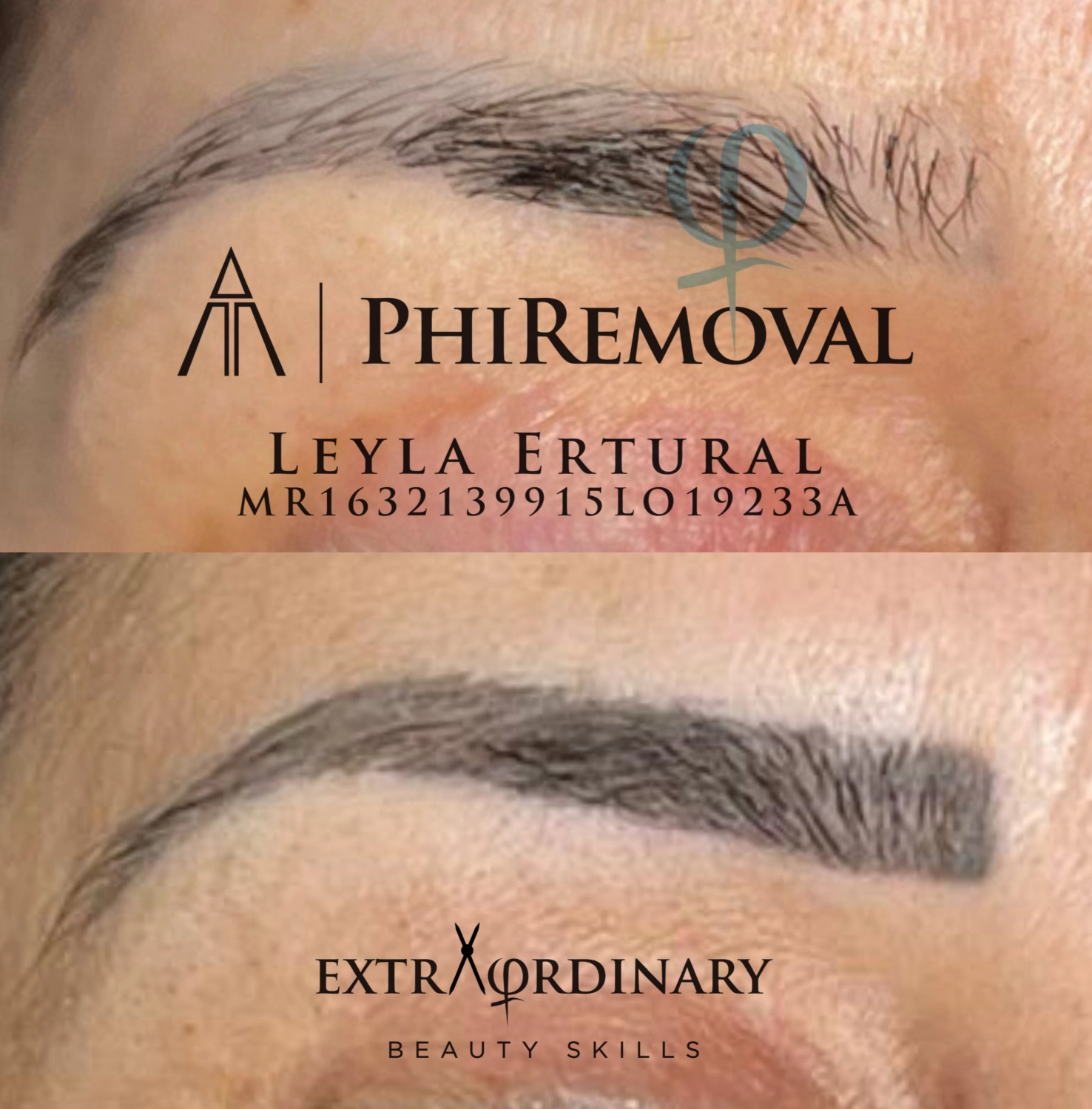 PMU-ENTFERNER PUREBEAU – Leyla Ertural