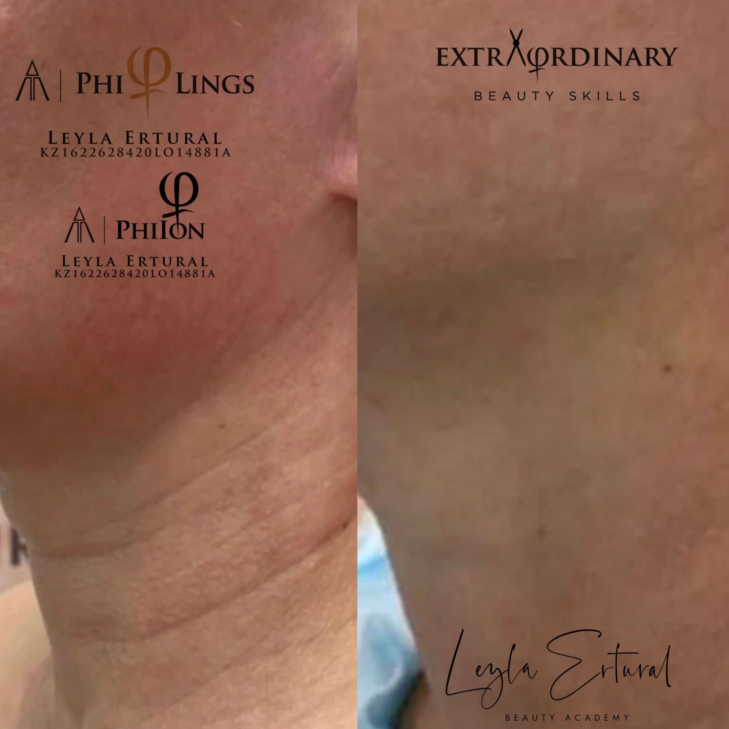 Vor und nach Radiofrequenz Needling – Leyla Ertural