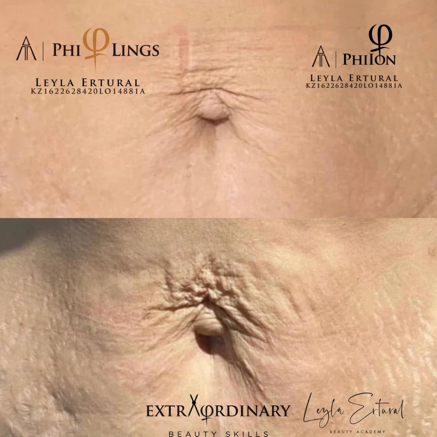 Vor und nach Radiofrequenz Needling – Leyla Ertural